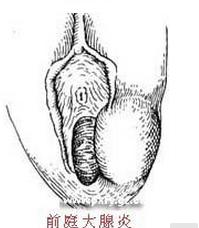 前庭大腺炎的主要症状和诊断标准