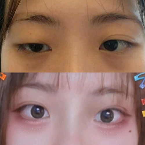 眼睛一只大一只小很明显怎么办