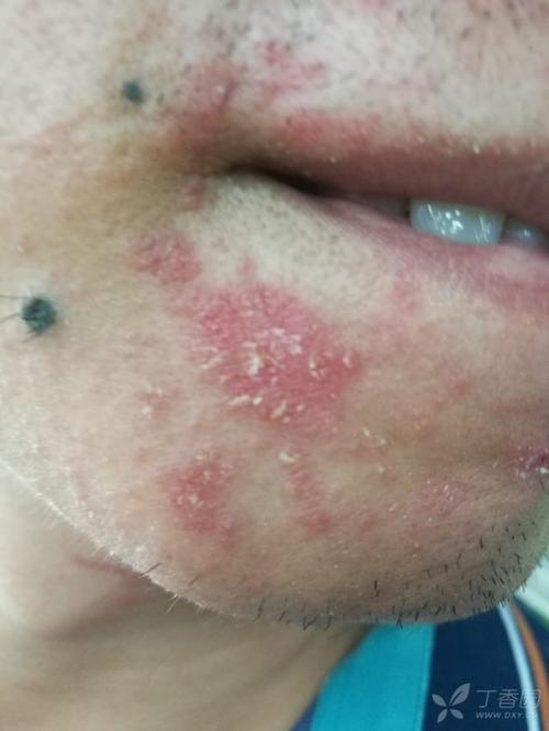 脸部长癣有五,六年了反复发作