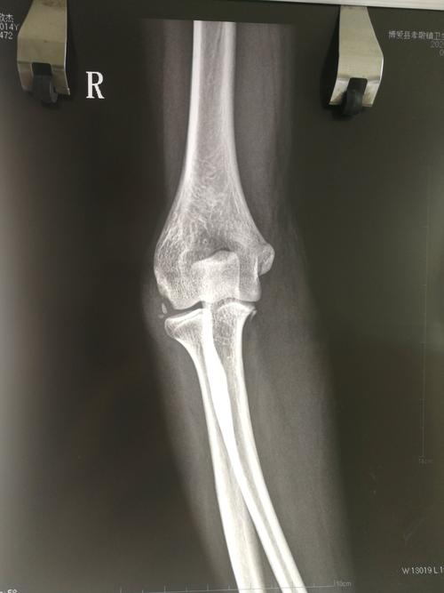 14岁男孩,右肱骨外髁撕脱骨折,尺骨鹰嘴骨折.看需不需要手术?