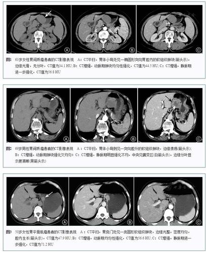 ct在胃平滑肌瘤和胃间质瘤鉴别诊断中的价值