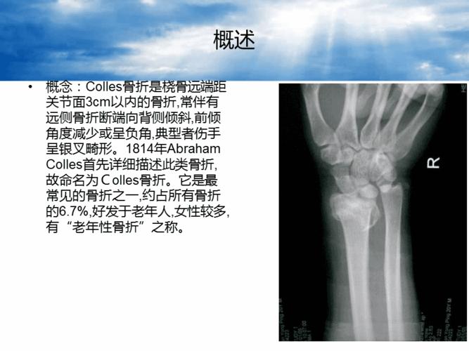 桡骨远端骨折colles骨折概述ppt