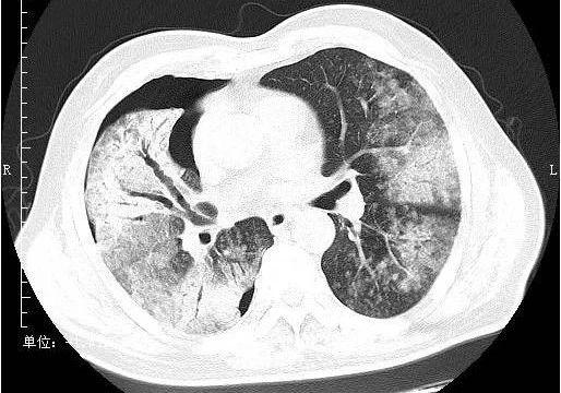 小叶性肺炎(支气管肺炎)