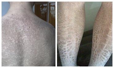 鱼鳞病_上海江城皮肤病医院