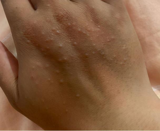 沙土性皮炎典型的皮疹特点