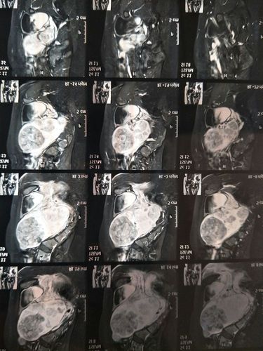 术前的磁共振显示的子宫内的多发肌瘤
