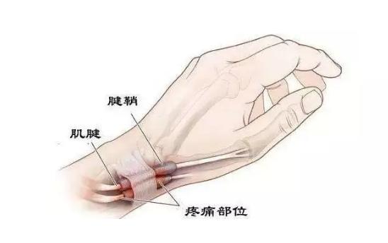 肌腱炎的病因有哪些?