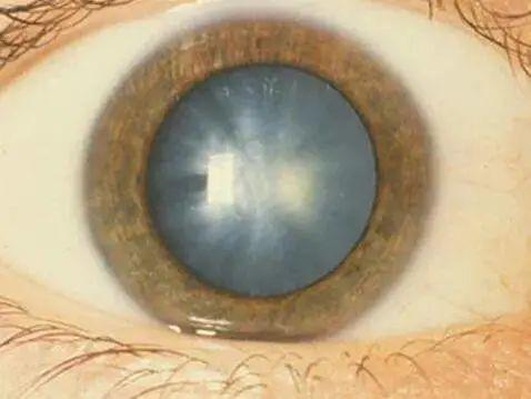 晶状体凸度增加,屈光近点发生改变的缘故,是白内障的早期症状之一