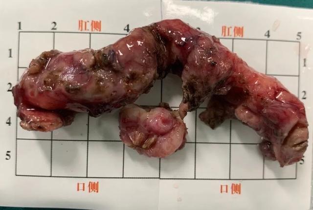 超微创手术切除恶性肿瘤,肚子上只见小眼儿