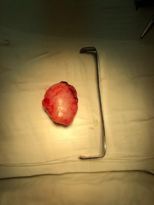 乳腺纤维瘤,良性.4cm.大于5cm就要排除分叶状肿痛