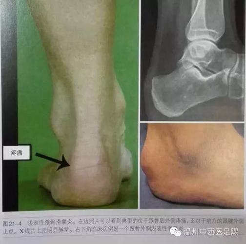 止点性跟腱炎haglund畸形与跟腱滑囊炎