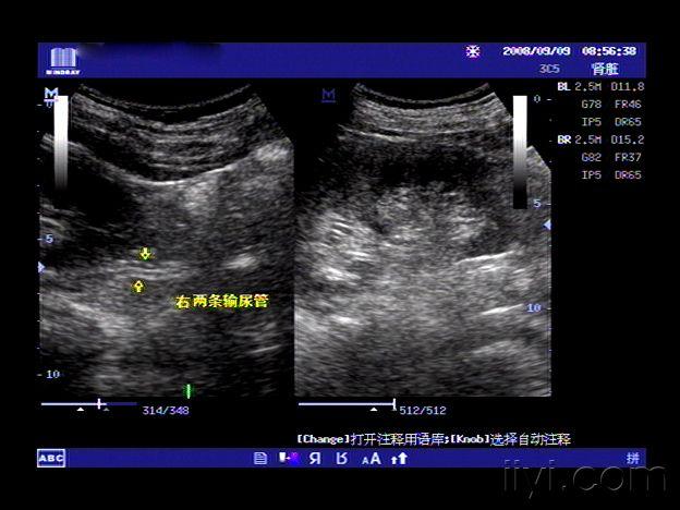 【贴图】双肾盂,双输尿管畸形