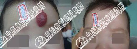 孩子额头上长了个大红疙瘩是怎么回事_胎记血管瘤科普网