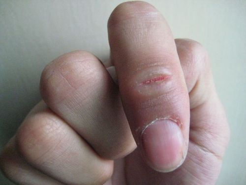 (80分)手指关节开裂,数月不愈合,如图