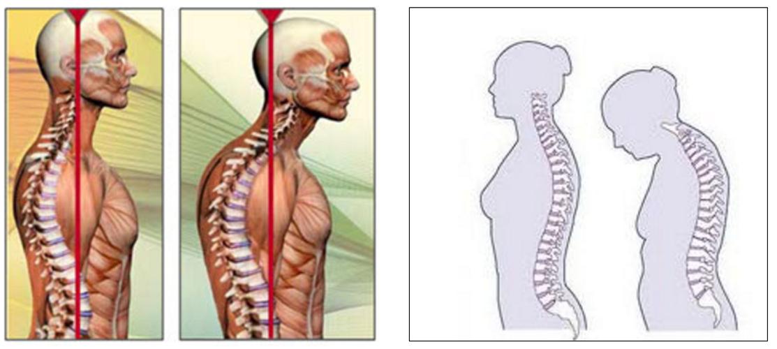 体态的力量(5):驼背(kyphosis)