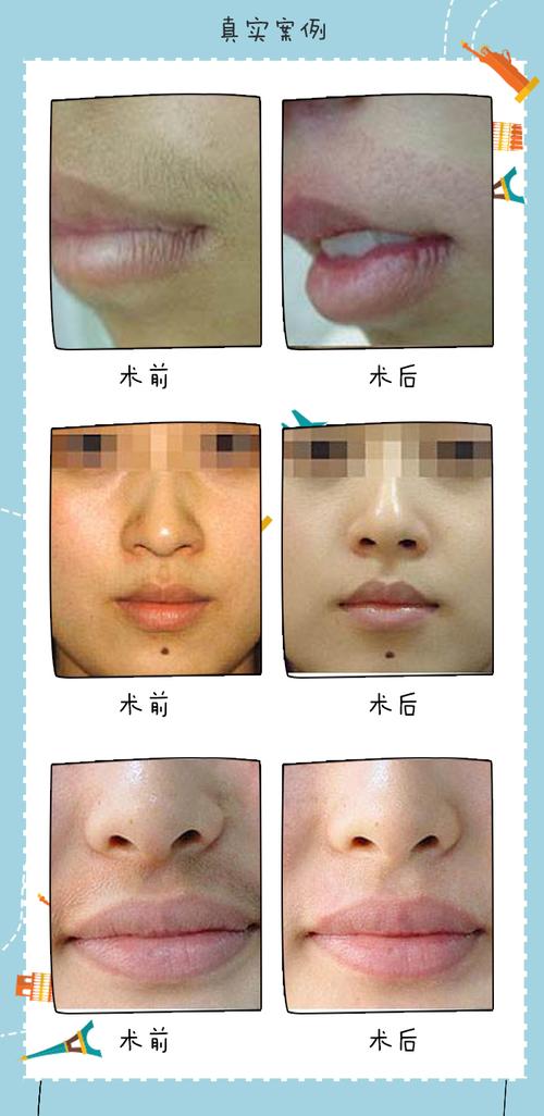 杭州进口激光脱唇毛包年 月光 冰点 超冰 脱毛