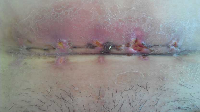 [2014年11月妈妈帮]剖腹产刀口缝线反应,怎么办?好吓人!