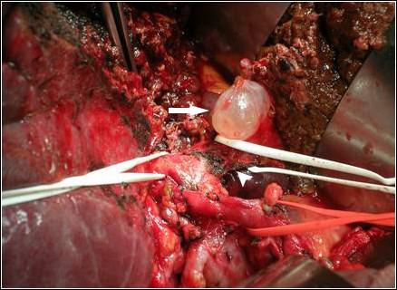 左肾小囊肿的病因