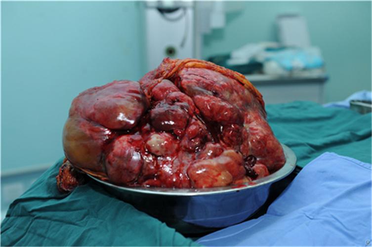 切除的腹腔恶性肿瘤图片