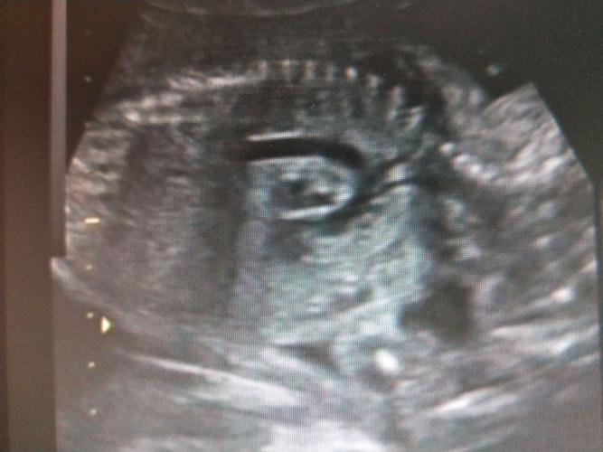 四维彩超检查常用切面.