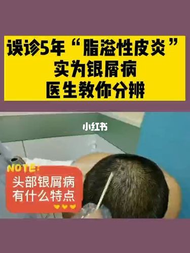 错把脂溢性皮炎当成银屑病,这样做分辨它们_脂溢性皮炎_银屑病_牛皮癣