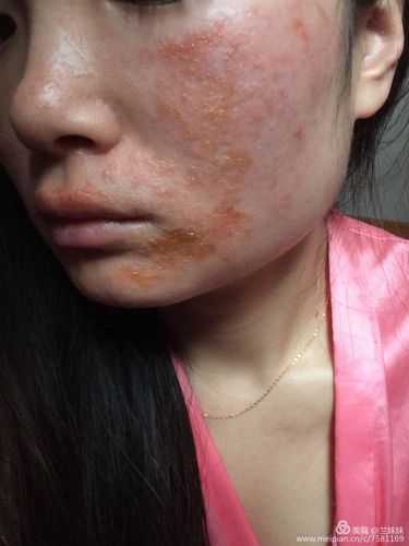 中国本身就是一个激素脸大国,对于激素脸的调理我有非常好的实战经验