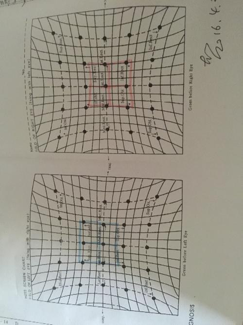 双眼同时看东西出现复视,头向左侧偏明显,hess检查结果如图,是什么