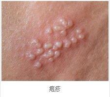 疱疹病毒感染