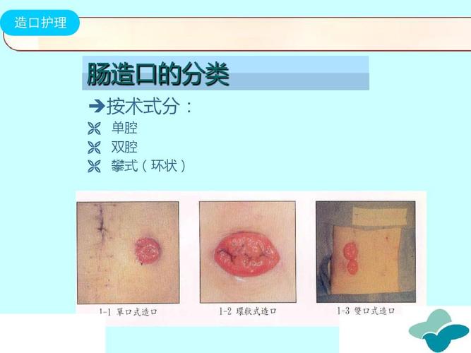 无忧文档 所有分类 肠造口病人的护理.