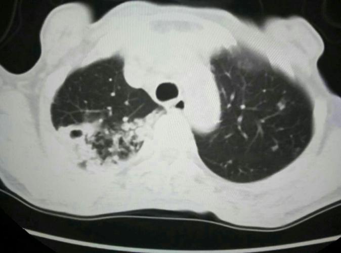 肺结核相关知识点--王俊豪老师