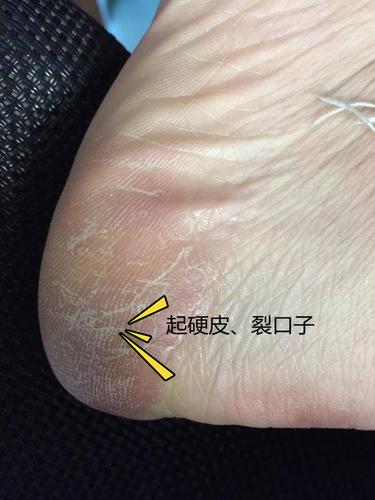 【医生回答】王豫平 主任医师 河南省人民医院 皮肤科