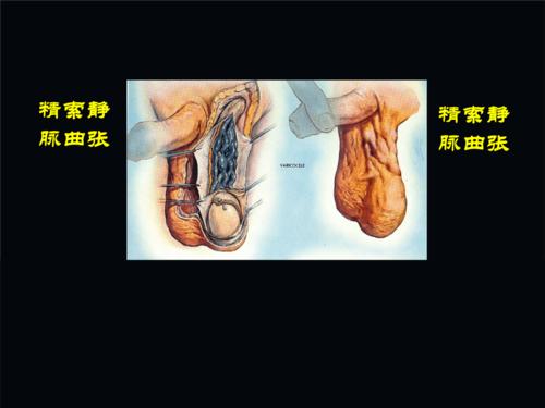 《精索静脉曲张》ppt课件.ppt
