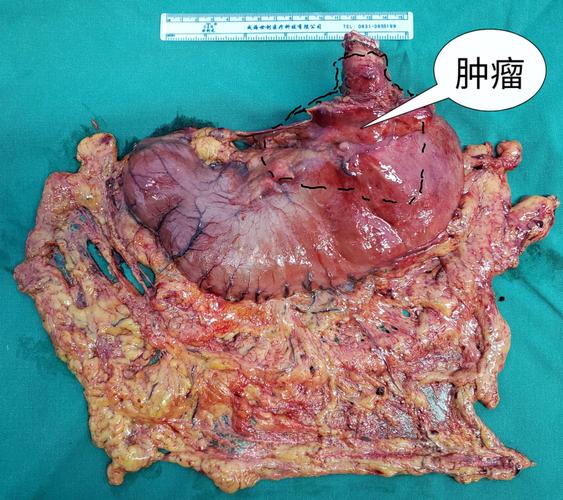 完成"全胃切除术".