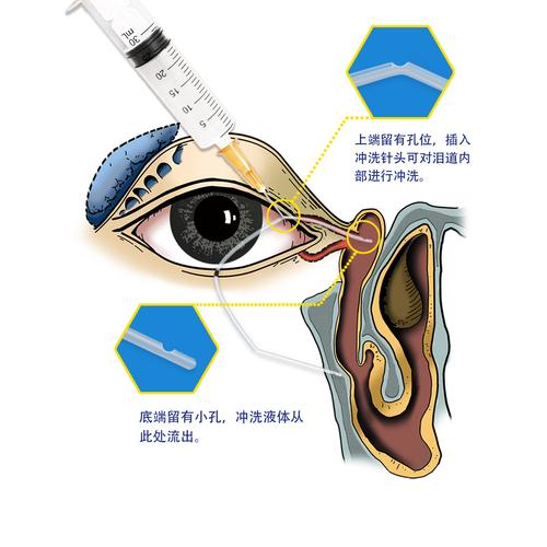 一次性使用型泪道引流管ts型