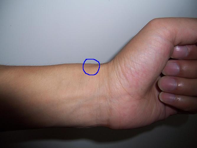 求助:手腕关节痛! 100分求助!