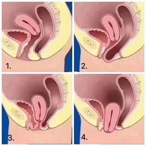 什么是产后阴道前后壁膨出,子宫脱垂的问题(请看图97 97 97 )