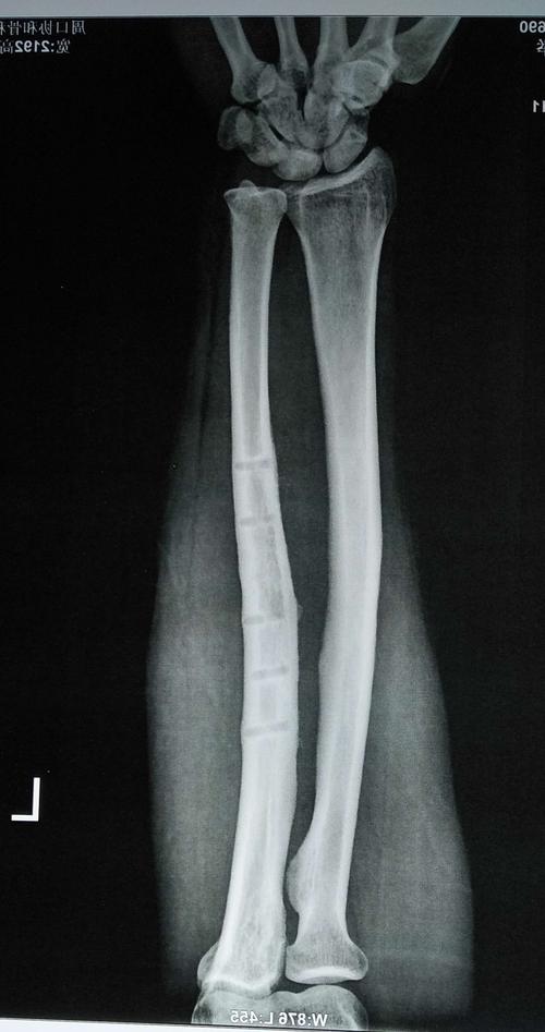 术后x线片提示:原骨折处愈合良好,钢板内固定完全取出.