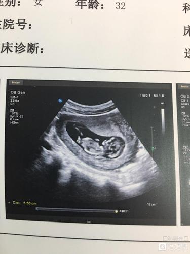 11周 4,nt顺利通过,小宝宝继续加油