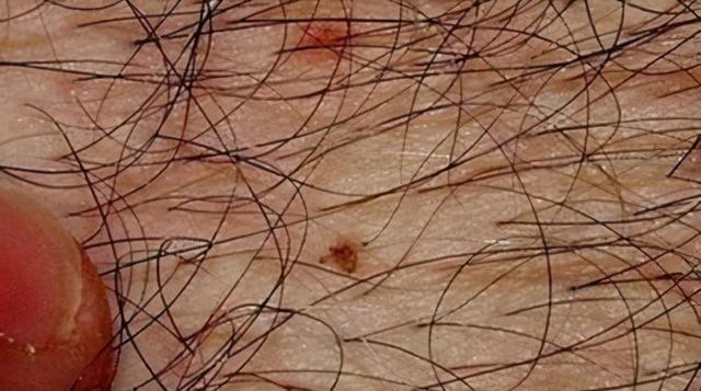 其实阴虱病主要和阴虱虫有关,从医学上来看,他主要是一种能够寄生在