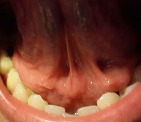 舌头下方根部长肉芽