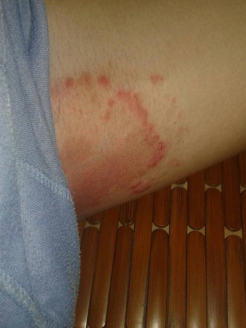 请问这个是不是湿疹?