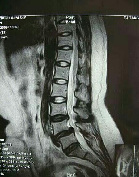 腰椎间盘突出症诊断与治疗2018-8-15