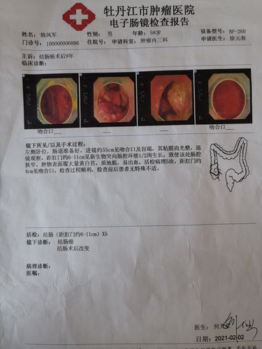 结肠镜检查,盲肠吻合口,直肠吻合口可见,直肠吻合口上2厘米肿瘤复发.