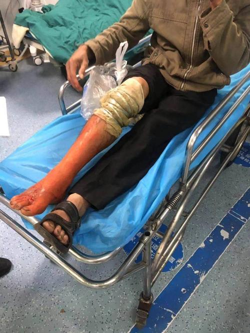 老人又红又肿的腿