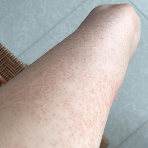 去鸡皮肤#毛周角化症# 图片一二是我手臂最开始的状态 图片三四是疙瘩