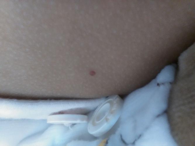 作为一个婴儿血管瘤医生,给大家讲解一下血管瘤