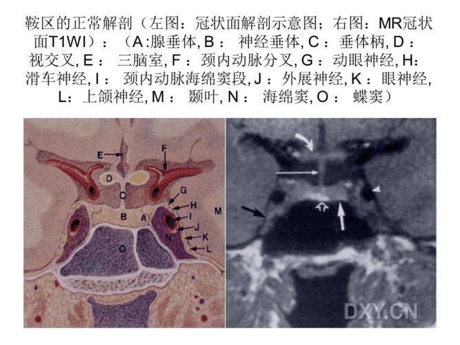 鞍区解剖及病变的mr改变课件