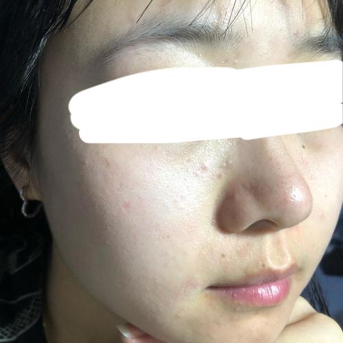 脸上这些小疙瘩是丘疹吗