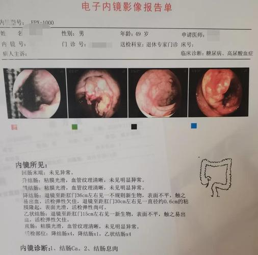 但天不遂人愿,等父亲做完肠镜,结果显示: 结肠癌!