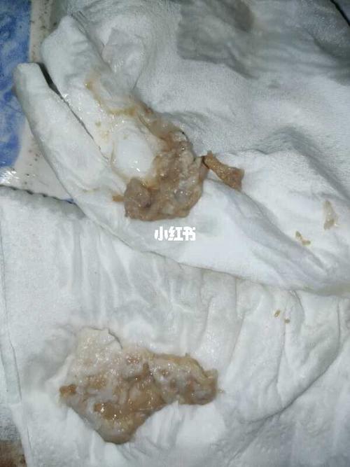 这就是排出来子宫垃圾_子宫_宫颈糜烂_宫颈糜烂霉菌盆腔炎_医疗健康